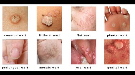 Elan Skin Care Clinic | Blog |finding-the-right-treatment-for-warts ...