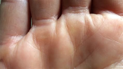 how to get rid of calluses on your hands from lifting - YouTube