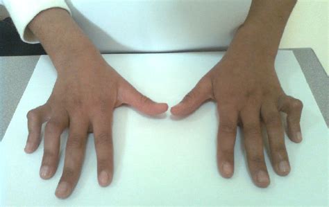 Flexion Contracture