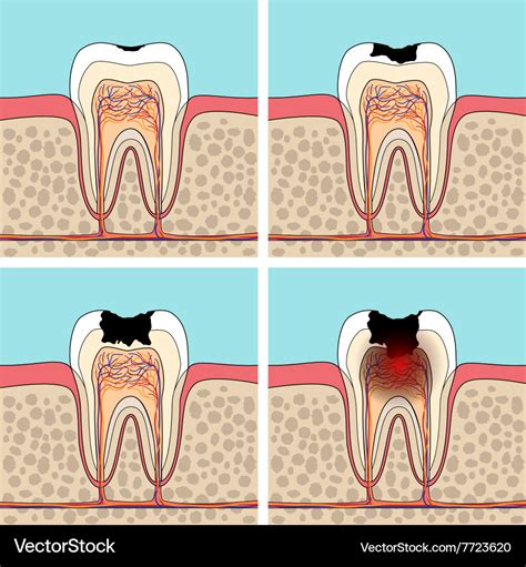 Dental caries stages Royalty Free Vector Image