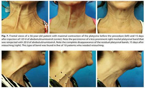 Botox For Neck Rejuvenation » Facial Injections: Info, Prices, Photos, Reviews, Q&A