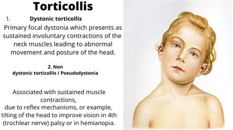 Causes of Torticollis - Neurological Surgery