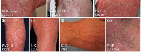 Overview of the revertant skin phenotypes in different genodermatoses ...