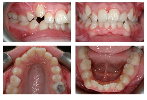 Teeth Before And After Braces Crowding