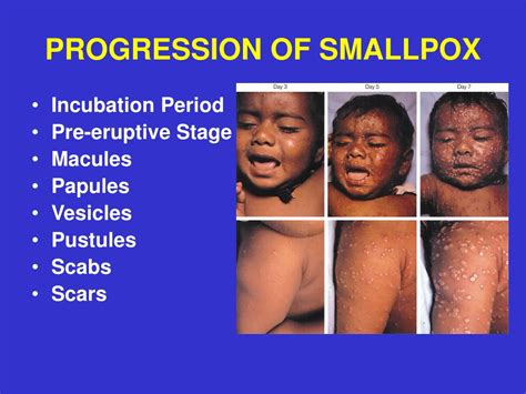 PPT - SMALLPOX PowerPoint Presentation, free download - ID:9291082