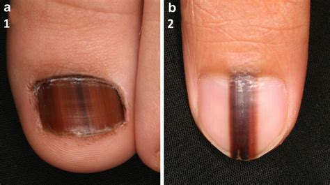 what does melanoma look like under a fingernail | Symptoms and pictures