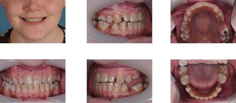 Dentin Dysplasia Diagnostic Challenges Bmj Case Reports | My XXX Hot Girl