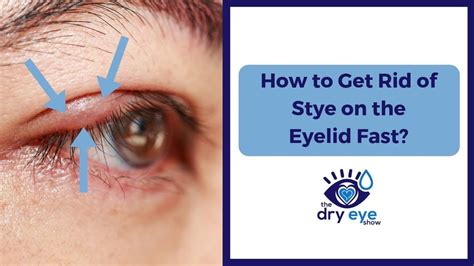 👁️👁️ How to Get Rid of a Stye On the Eyelid Fast 👁️👁️ | Eye stye ...