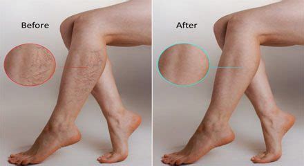 Varicose Veins Laser Treatment Recovery Time | Potent Medical