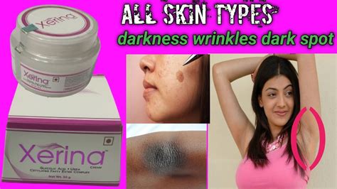 Xerina Cream Hindi Use! All Skin Types! Uses! Side Effects! Benefits # ...