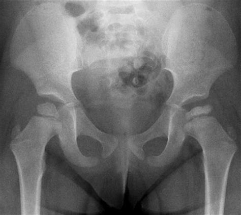 Legg-Calve-Perthes Disease - Pediatrics - Orthobullets