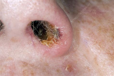 Vestibulitis of the nose - Stock Image - C011/1657 - Science Photo Library