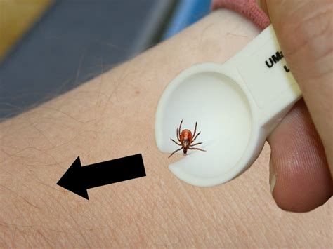 Tick Removal - Cooperative Extension: Tick Lab - University of Maine Cooperative Extension