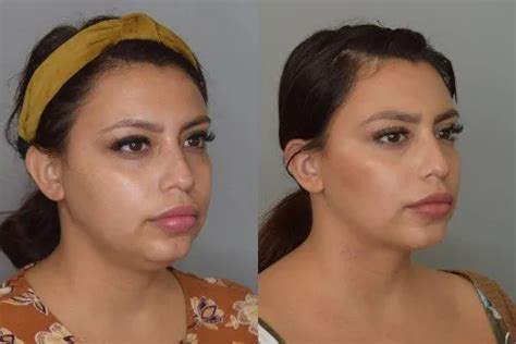 Chin Lipo Before and After: The Anatomy - Best Chin Lipo Results