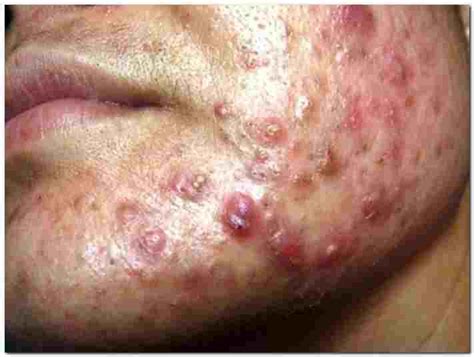 Acne Conglobata – Causes & Treatment (Pictures) | Actforlibraries.org