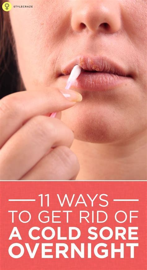 How To Get Rid Of Cold Sores – 20 Home Remedies And Other Treatments ...