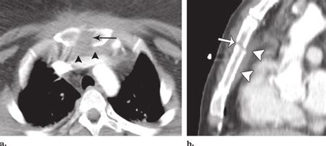 Sternal fractures. (a) Axial CT scan (soft-tissue window) shows a... | Download Scientific Diagram