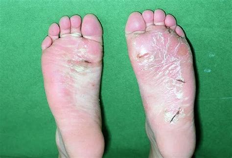 Pulpitis or plantar dermatosis Causes and Treatment | Mediologiest