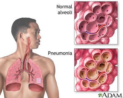 Pneumonia: MedlinePlus Medical Encyclopedia Image