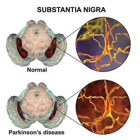 Parkinson : causes, symptômes et traitements | Creapharma