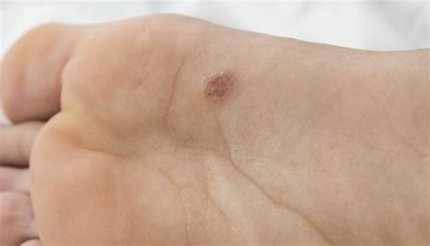 Acral lentiginous melanoma: 8 questions about this rare skin cancer ...