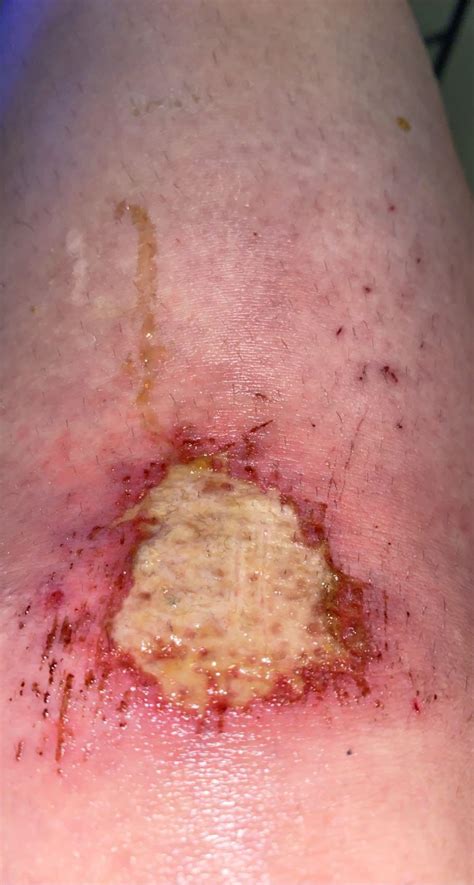 infected (i think) scrape on my knee that i got from tripping over my ...