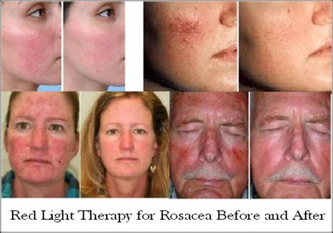 Red Light Therapy-Reduce Wrinkles, Age Spots, Acne, & More!