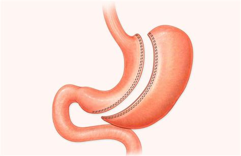 Sleeve Gastrectomy Has Lower 5-Year Mortality, Complication, and Reintervention Risk Than ...