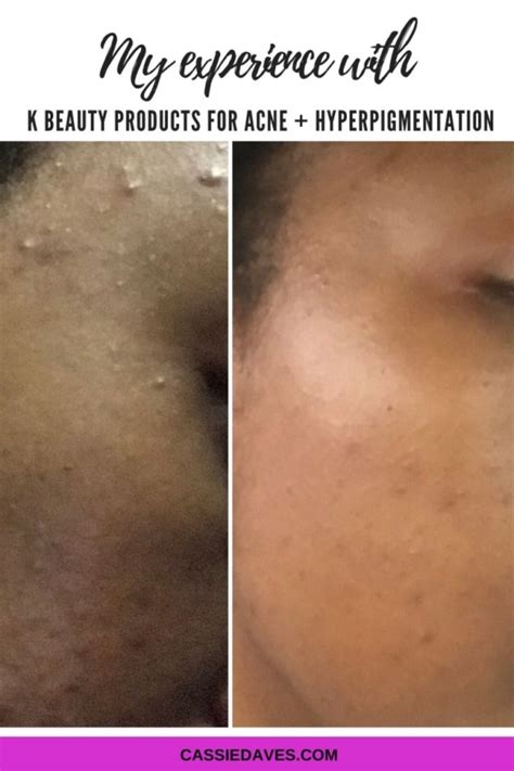 Before And After - My Experience With Korean Beauty Products For Acne.