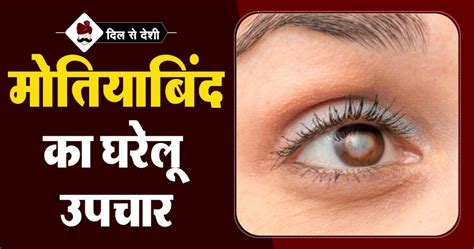 मोतियाबिंद का घरेलु उपचार | Cataracts Home Remedies Treatment in Hindi