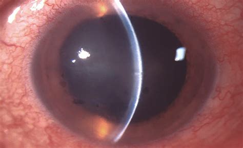 Fuchs corneal endothelial dystrophy