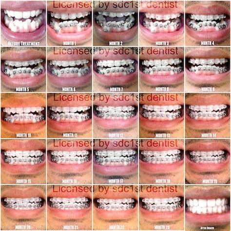 Braces Before And After Timeline | Before And After