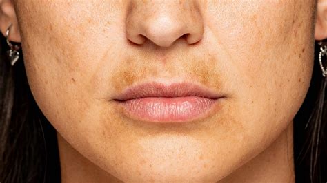 Melasma Mustache | Ohio State Health & Discovery