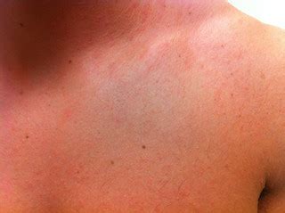 25 yo w/ rash after ketoconazole shampoo for presumed ring… | Flickr