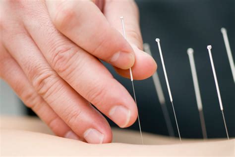 Acupuncture Needles For Hair Growth at Monica Reid blog