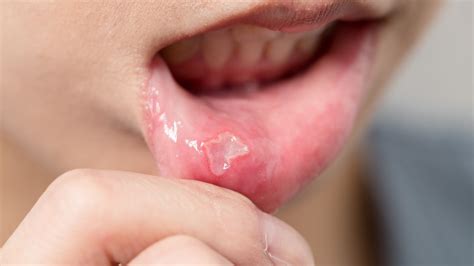 Oral Lesions, Ulcers, and Sores and How to Treat Them - Danville Family Dentistry