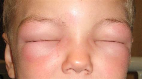 Cellulitis Face Treatment - Doctor Heck