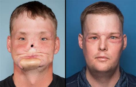 Mayo clinic face transplant surgery gives man a new start in life - NorthIowaToday.com