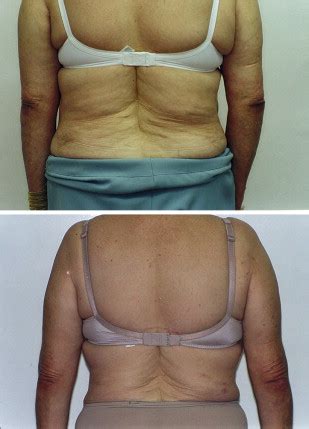 The Lipodissolve Technique: Clinical Experience - Clinics in Plastic Surgery