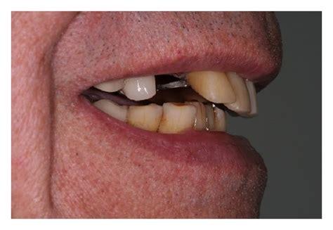 (a) Preoperative view demonstrating failing maxillary dentition. The ...