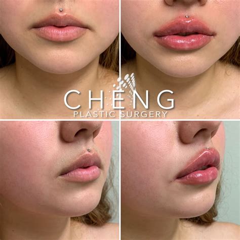 Lip Filler Before & After u2728 | Lip fillers, Lips, Lip injections