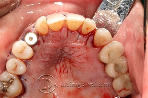 Impacted canine: extraction + implant + graft - DL Oral Surgery