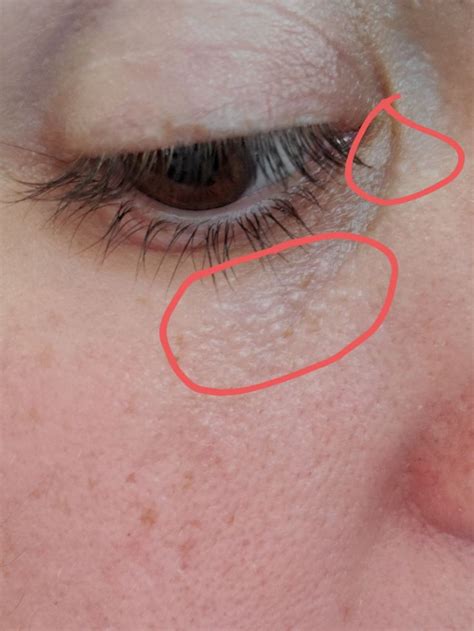 Under Eye Bumps, NOT milia | Bumps under eyes, Dry skin under eyes, Dry skin around eyes