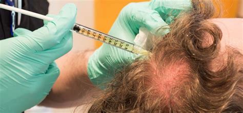 Treating Androgenetic Alopecia with PRP Therapy (With images) | Androgenetic alopecia, Hair loss ...