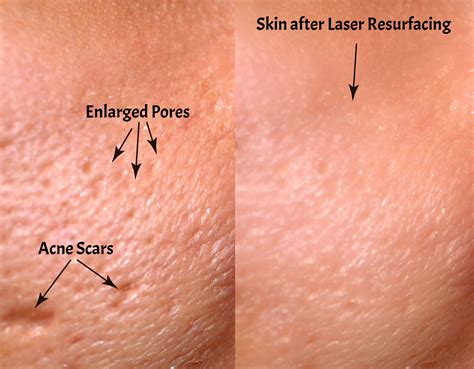 Laser Stretch Mark Removal in Troy, MI Get Smooth Skin Fast!