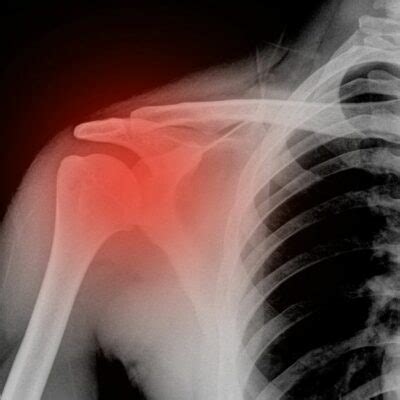 Shoulder Fracture | Shoulder Specialist | South Windsor, Enfield ...