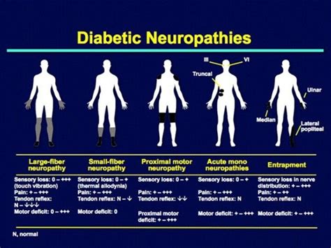 Diabetic neuropathies This pin brought to you by Dr. Robert Odell http://robertodellmdphd.com ...