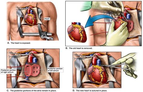 Heart Transplants in New Jersey | RWJBarnabas Health