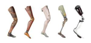 The above knee amputations : Indication, Physiotherapy, Prosthesis