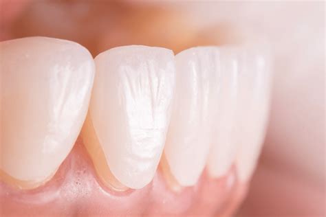 EMAX Laminate Veneers - Implant Treatment in Turkey - Implant Prices, Treatment Packages ...